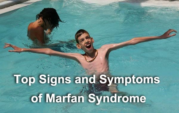 Top Signs and Symptoms of Marfan Syndrome - RespectCareGivers