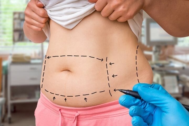 BBL and Tummy Tuck Recovery