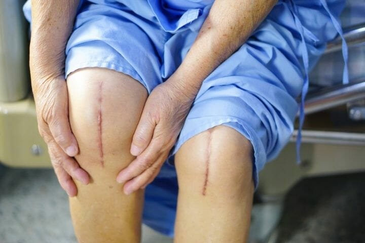 Caregiver's Guide to Knee Replacement