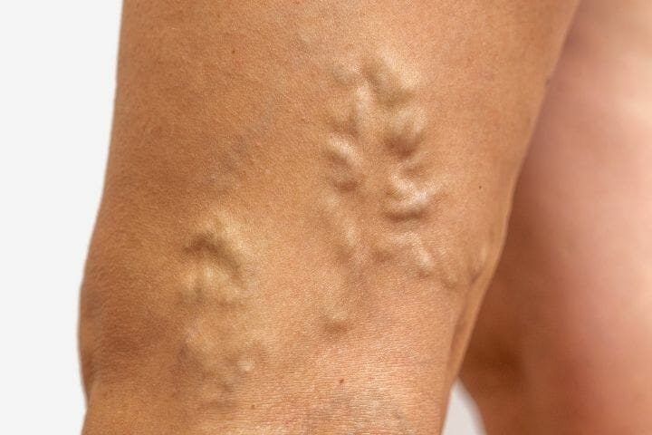 Taking Care of Varicose Veins As You Age