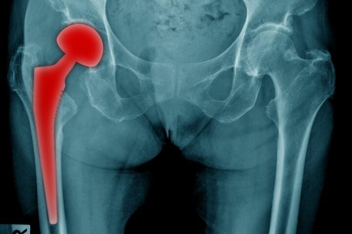 Hip Replacement - The Complete Guide For Caregivers And Seniors