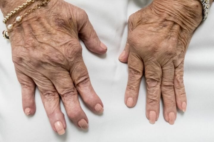 Arthritis: The Ultimate Guide For Seniors And Caregivers