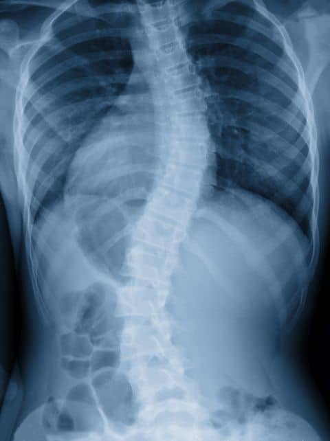 Abnormal Spine Curvature Scoliosis