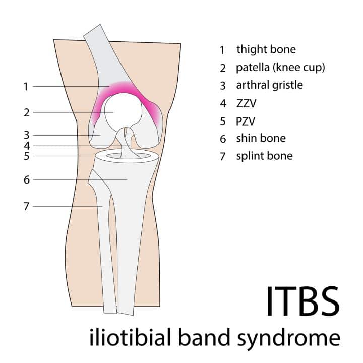 Best Shoes For ITB Syndrome