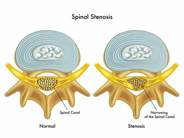 Best Mattress For Spinal Stenosis