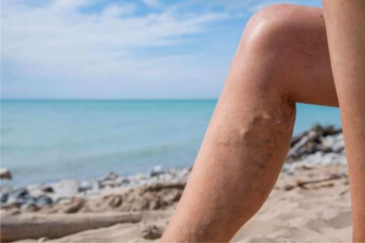 can varicose veins cause restless leg syndrome