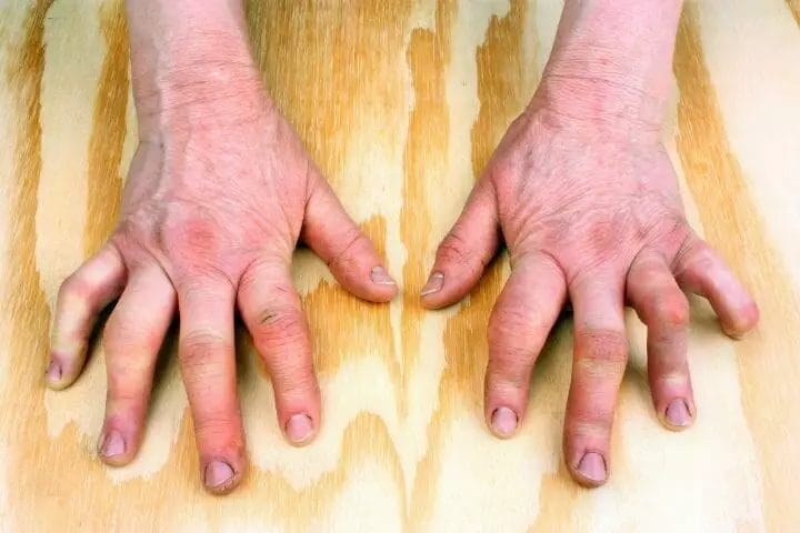 Best Climate For Rheumatoid Arthritis