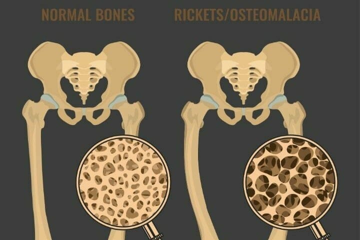 Difference Between Osteoporosis And Osteomalacia RespectCareGivers   Difference Between Osteoporosis And Osteomalacia 1 