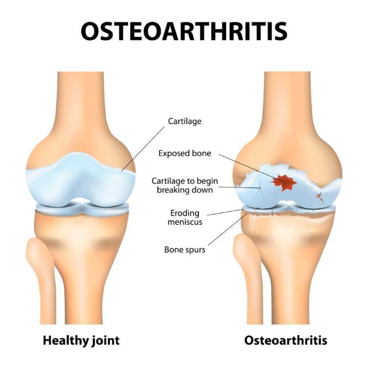 Signs and Symptoms of Osteoarthritis