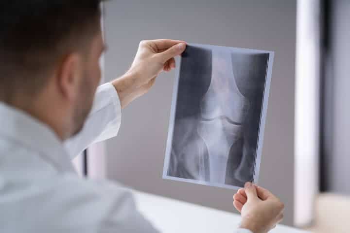 What Is Knee Replacement