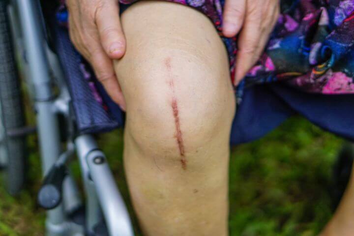 scar after knee replacement surgery