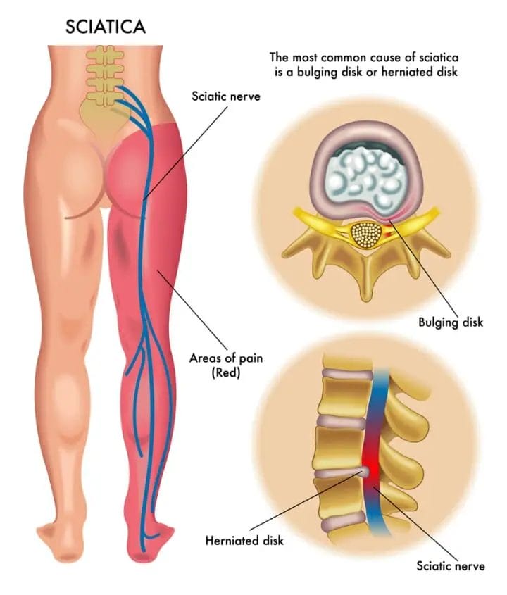Can You Get Disability For Sciatica