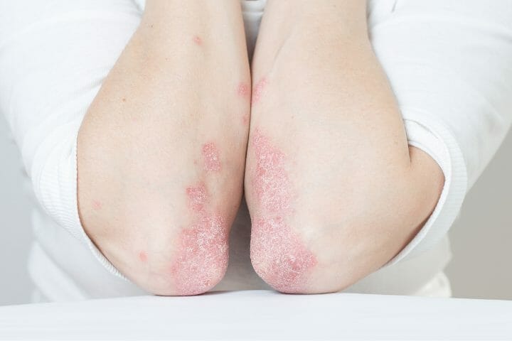 Can You Get Disability For Psoriatic Arthritis? - Respectcaregivers