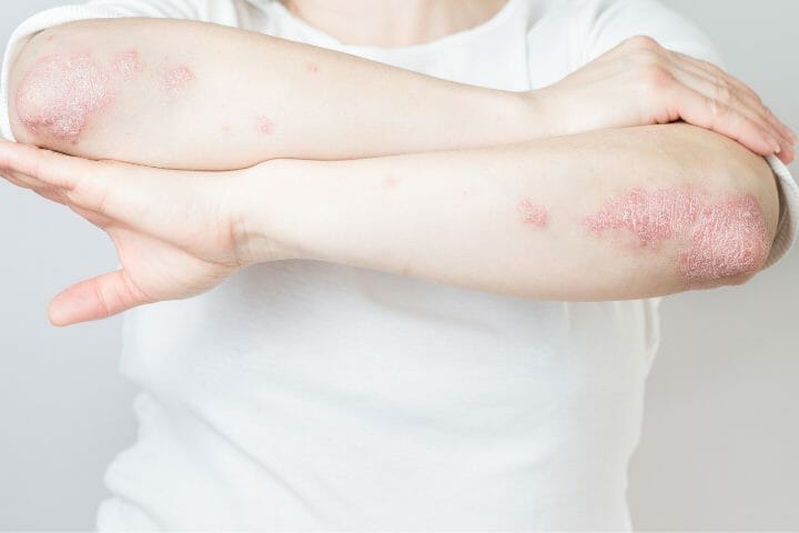 Can You Get Disability For Psoriatic Arthritis? - Respectcaregivers