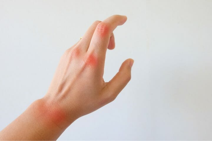 Can You Get Disability For Psoriatic Arthritis? - Respectcaregivers