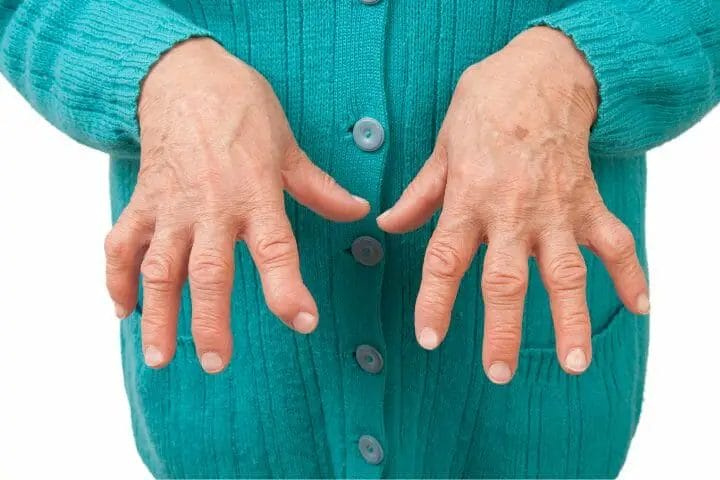 Is Rheumatoid Arthritis A Disability
